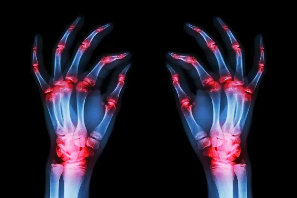 artroza sklepov prstov