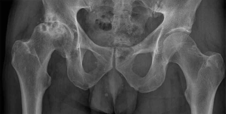 Artroza kolčnega sklepa 3. stopnje na rentgenskem slikanju