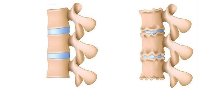 Osteohondroza od znotraj
