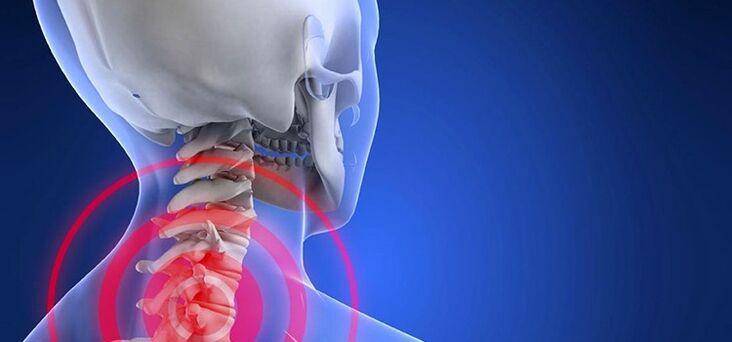 Osteohondroza regije materničnega vratu