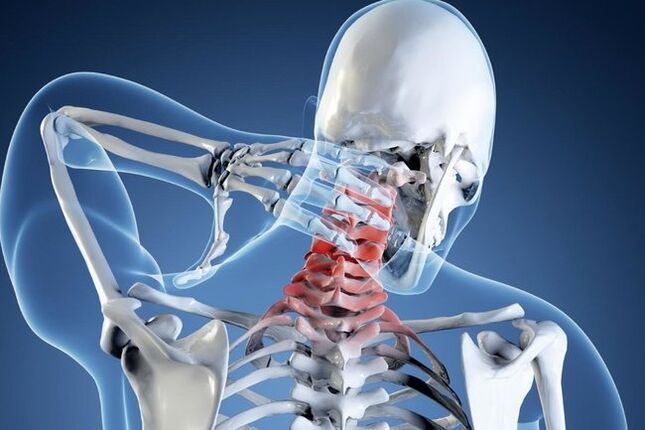 Osteohondroza regije materničnega vratu