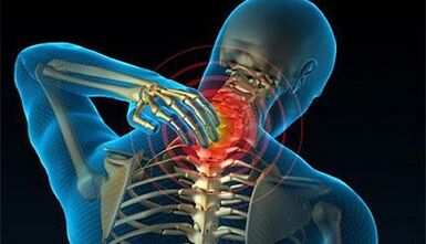 Simptomi osteohondroze vratne hrbtenice