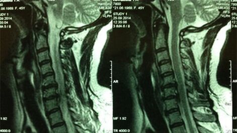 MRI oddelka za maternično vratu