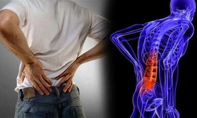 Razlogi za razvoj ledvene osteohondroze