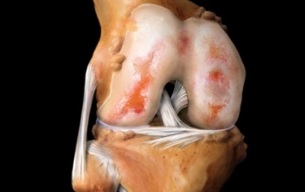 kaj je artroza kolena
