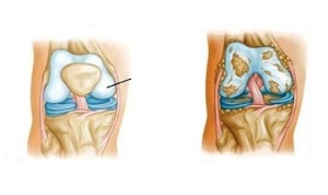 patološke spremembe artroze kolena