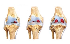 stopnje artroze kolenskega sklepa