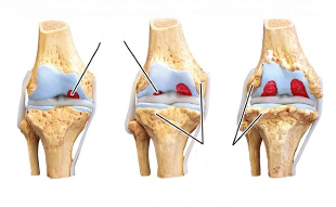 stopnje artroze kolena