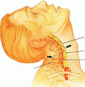 Osteohondroza vratne hrbtenice