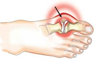 Vnetje sklepa med palcem in stopalom pri artritisu
