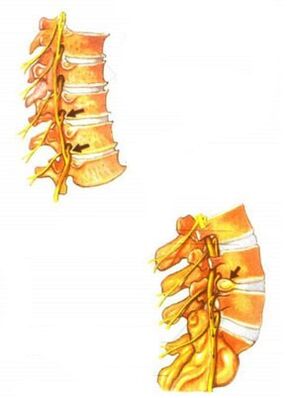ilustracija osteohondroze hrbtenice