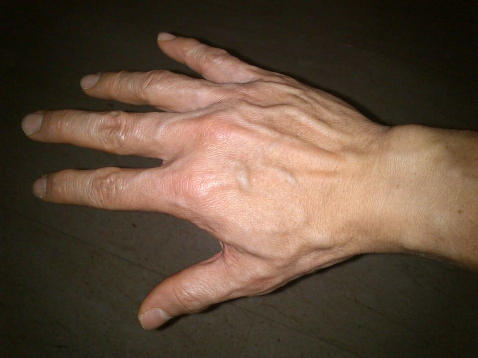 deformacije kosti in bolečine v sklepih prstov