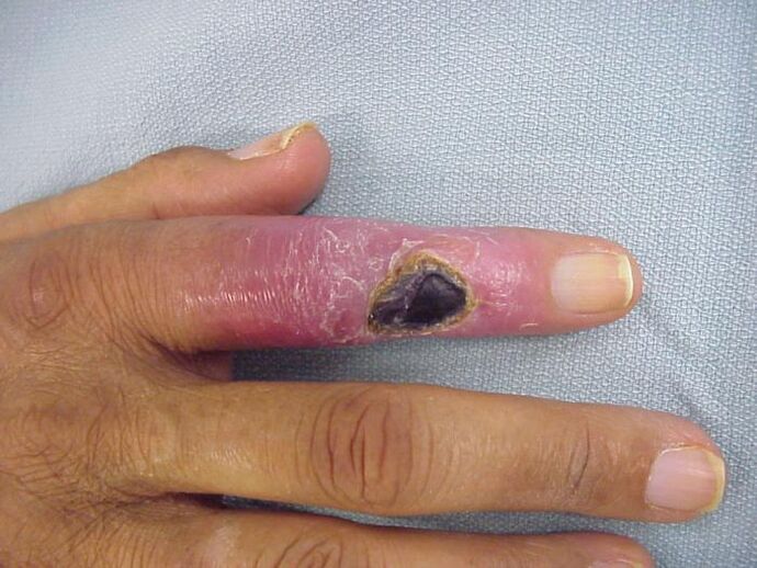 osteomielitis kot vzrok za bolečine v sklepih prstov