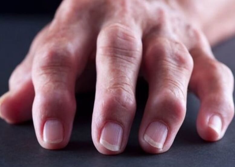 revmatoidni artritis kot vzrok za bolečine v sklepih prstov