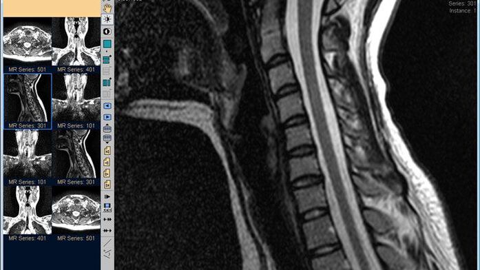 MRI vratne hrbtenice je najboljša metoda za diagnosticiranje bolečine v vratu