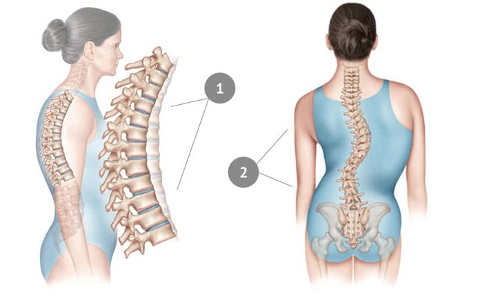 ukrivljenost hrbtenice kot vzrok torakalne osteohondroze