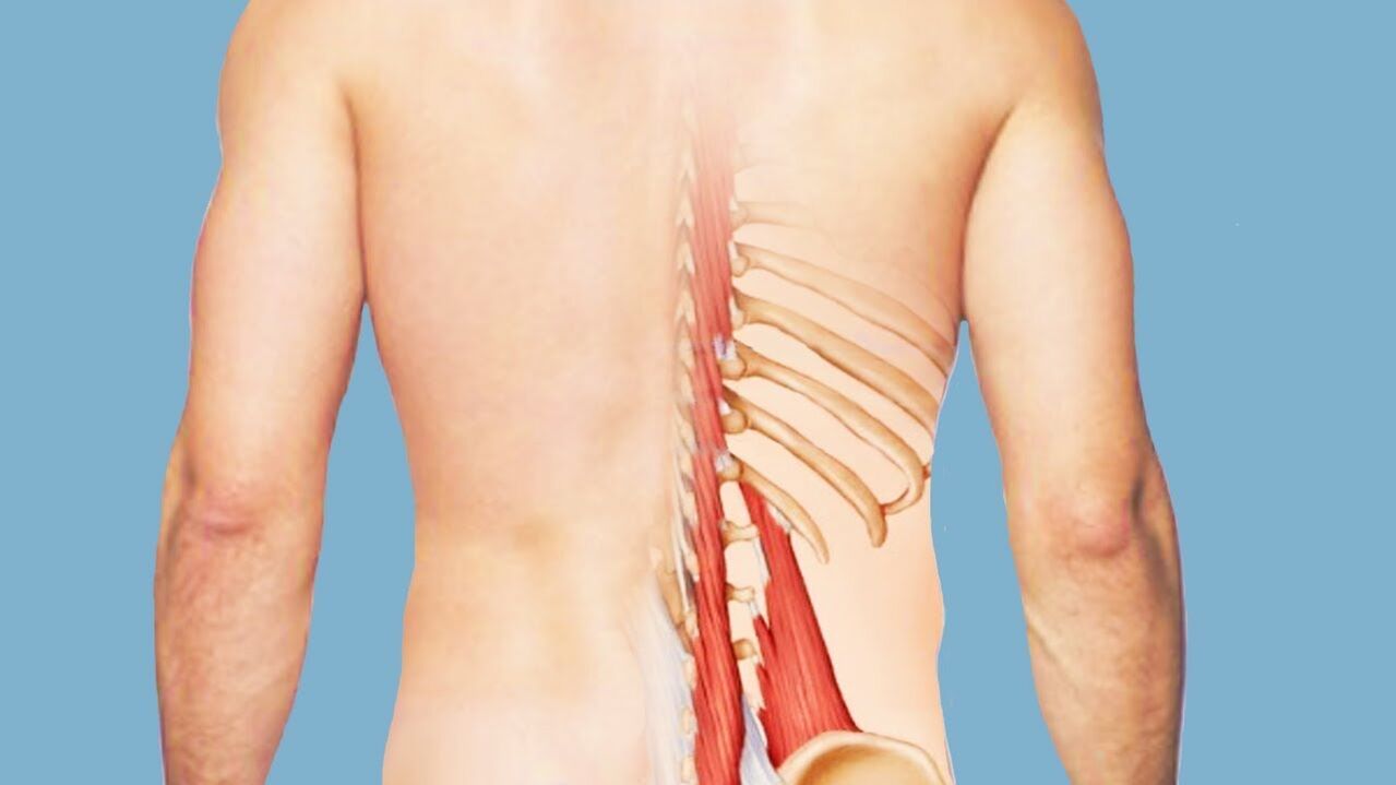 miozitis kot vzrok za bolečine v hrbtu
