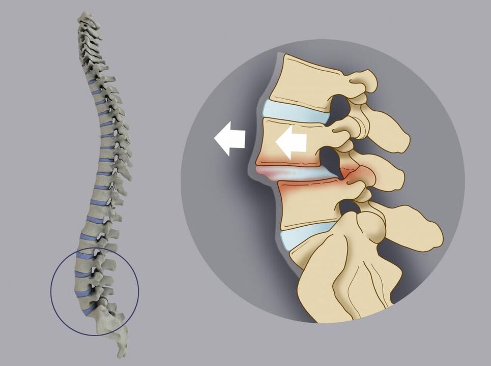 premik vretenc kot vzrok za bolečine v hrbtu