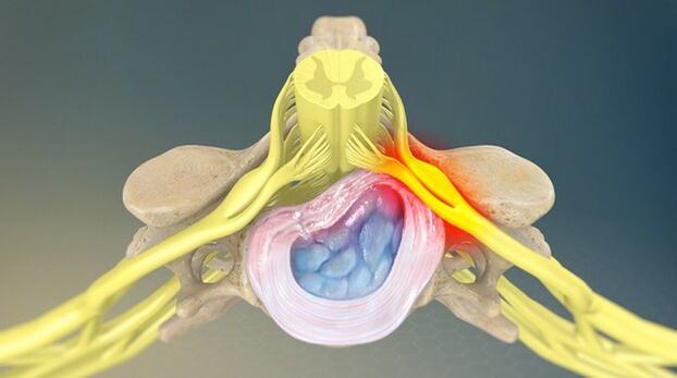 radikularni sindrom kot vzrok za bolečine v hrbtu