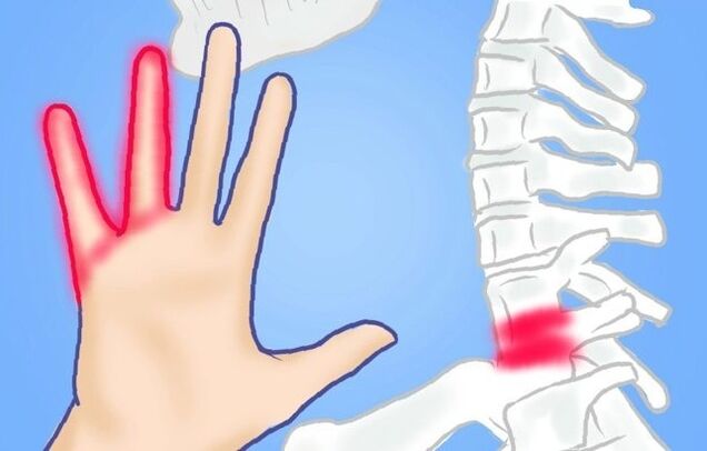 stisnjeni živci kot vzrok za bolečine v hrbtu