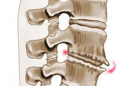 poškodbe vretenc s torakalno osteohondrozo