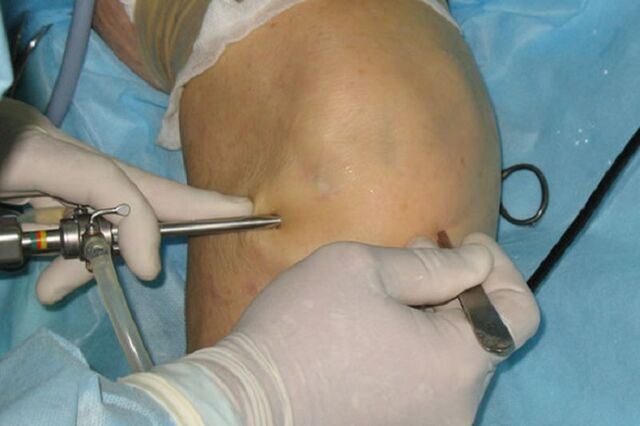 artroskopija za bolečine v kolenu